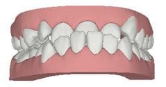 Types of Braces  Gehring Orthodontics
